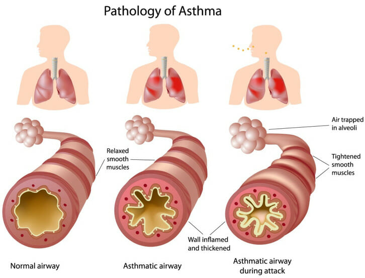 asthma.img