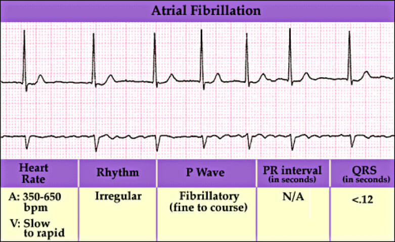 atrial-fibrillation.img