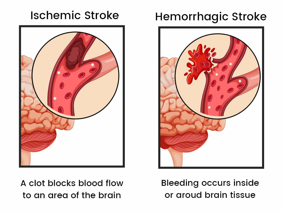 ischemic-and-hemorrhagic-stroke.img