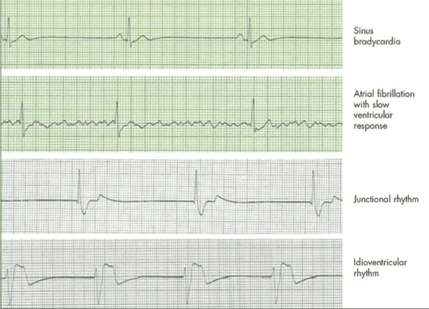 pulseless electrical activity acls