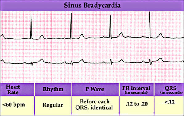 sinus-bradcardia.img