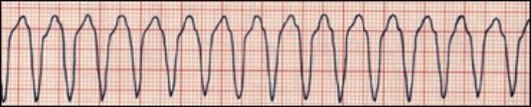 ventricular-tachycardia.img