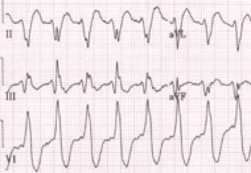 wide-complex-tachycardia.img