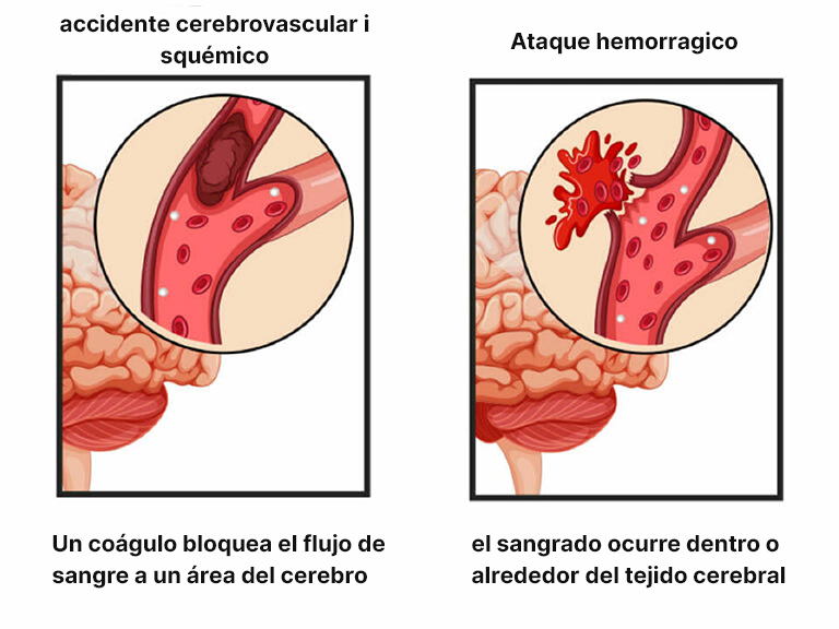 ischemic-and-hemorrhagic-stroke