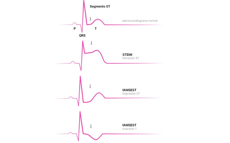 segment-elevation-myocardial-infarction