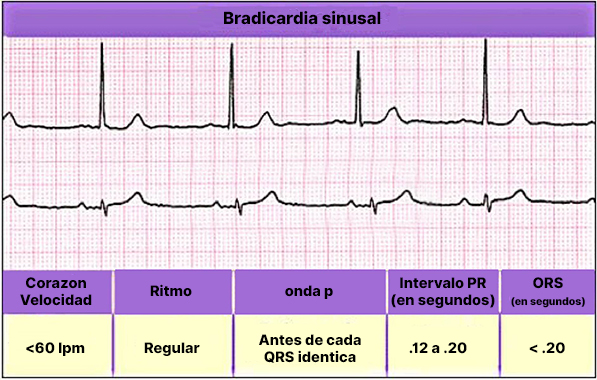 sinus-bradcardia