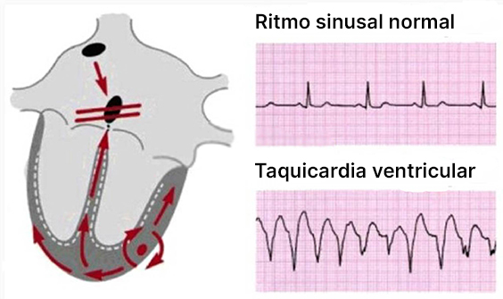 ventricular-tachycardia
