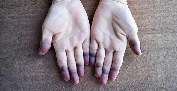 How to Diagnose, Treat and Prevent Hypoxia