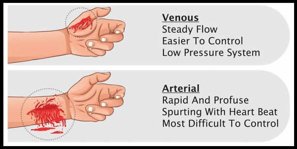  Difference Between Arterial and Venous Bleeding 