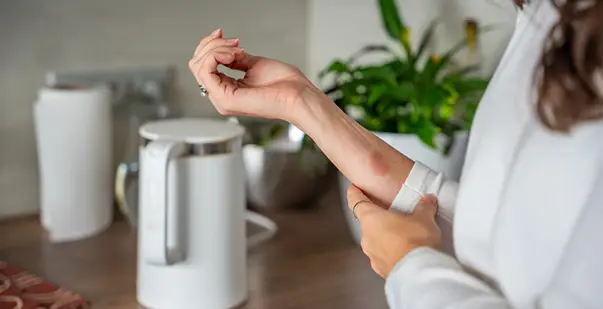 Kitchen-Safety-Preventing-and-Treating-Burns-and-Cuts-at-Home-Post-Img